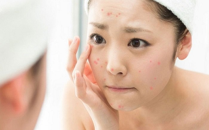 Nội tiết tố ảnh hưởng đến làn da của bạn như thế nào? | Vinmec