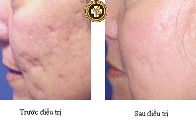 Hình ảnh trước và sau khi trị sẹo rỗ băng liệu pháp Vi phẫu biểu mô sinh học