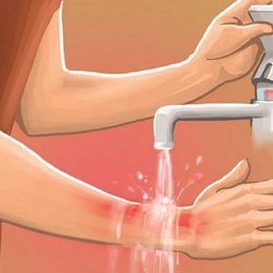 Làm sạch da dưới vòi nước mát là bước không thể thiếu khi muốn phục hồi da cháy nắng